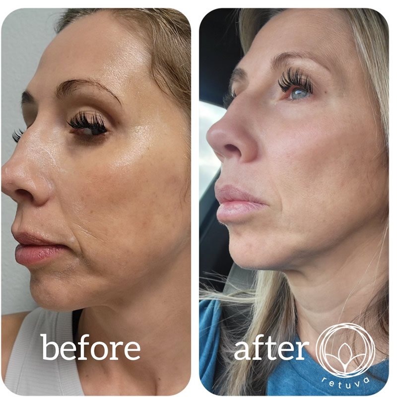 The Power of RF Microneedling with PRP Combination Treatments