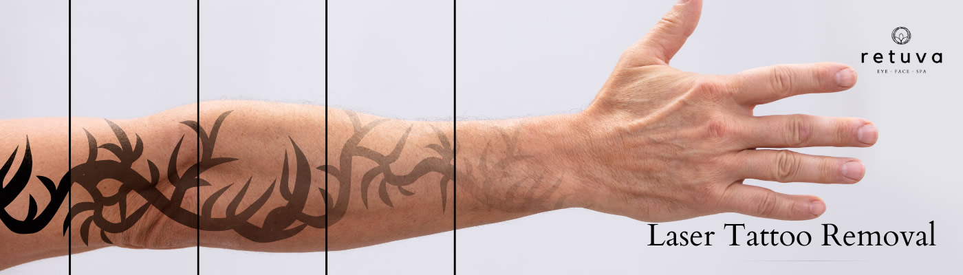 Tattoo and Scar Removal