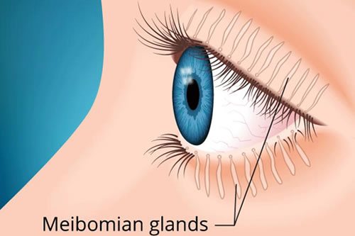 meibomian gland dysfunction